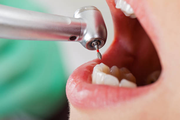 Best Urgent Care for Lost Fillings or Crowns in North Plainfield, NJ